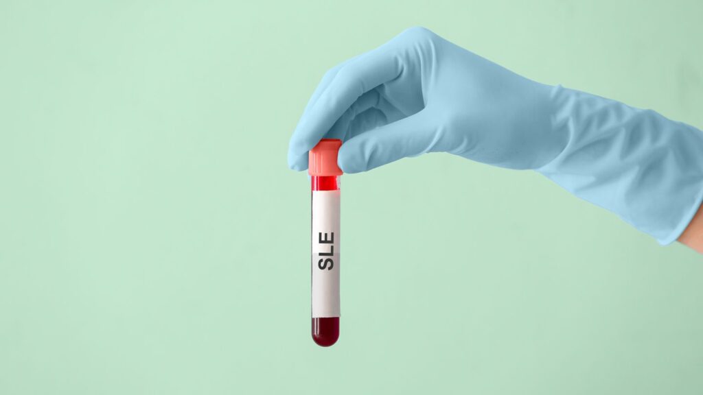 Is It Systemic Lupus Erythematosus (SLE) or Another Type of Lupus?