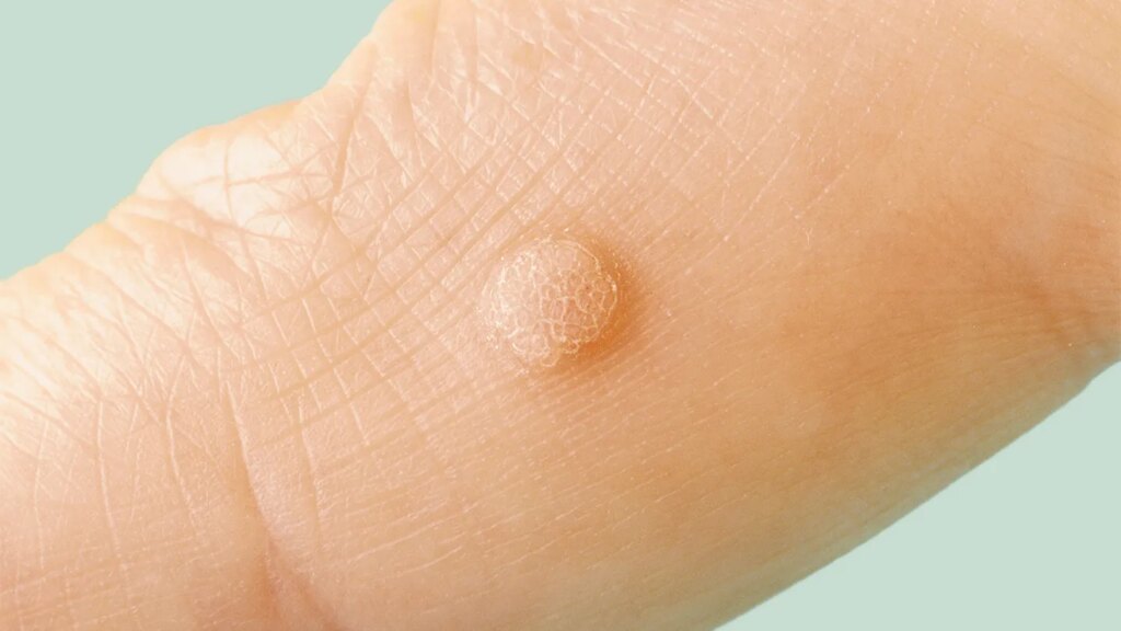 HPV Symptoms and Diagnosis