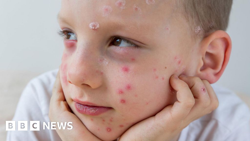 What is chickenpox and who can get the NHS vaccine? What is chickenpox and who can get the NHS vaccine?