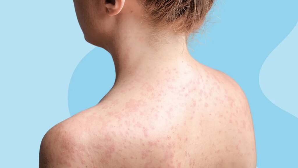 Can You Get Measles if You’re Vaccinated?