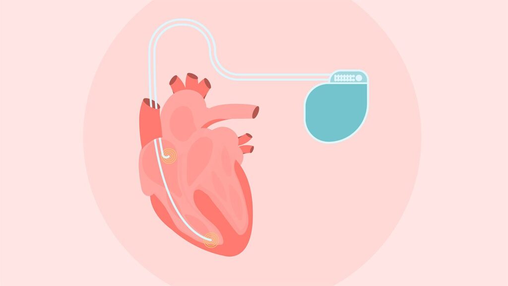 Hypertrophic Cardiomyopathy (HCM) and Implantable Devices: What to Know About ICDs (and Other Options)