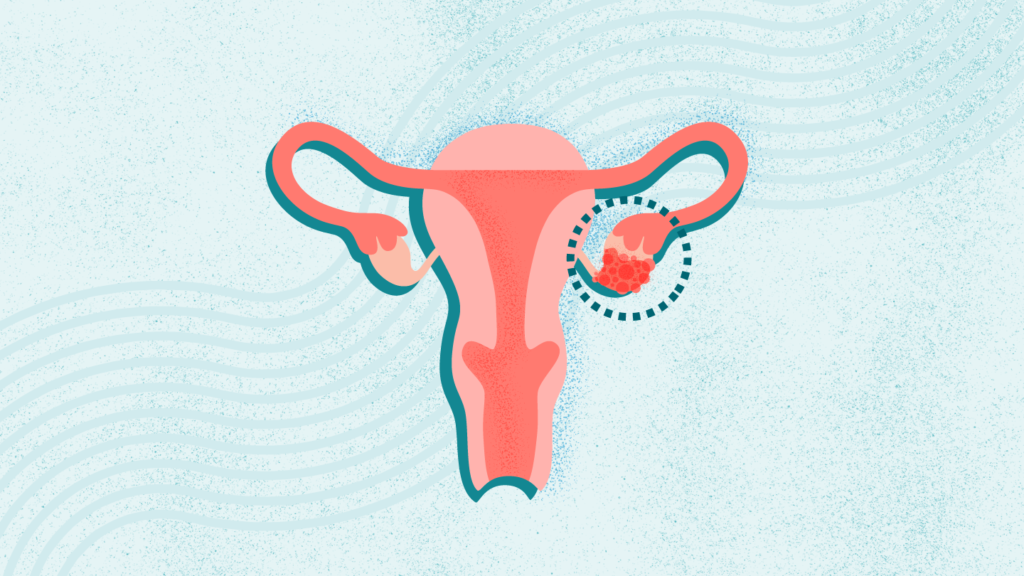 What Is Ovarian Cancer? Symptoms, Causes, Diagnosis, Treatment, and Prevention