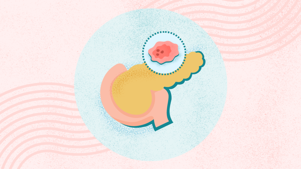 What Is Pancreatic Cancer? What Is Pancreatic Cancer?