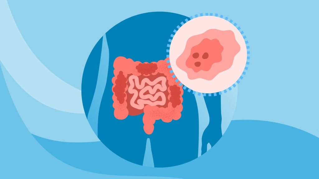 Early-Onset Colorectal Cancer What Is Early-Onset Colorectal Cancer?