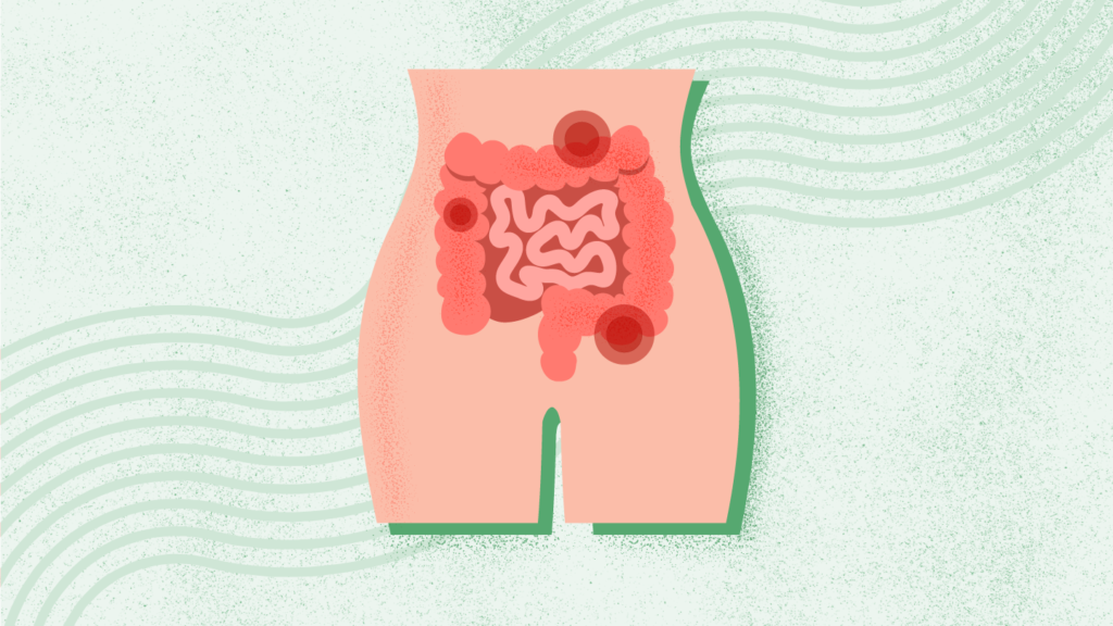 What Is Constipation? What Is Constipation?