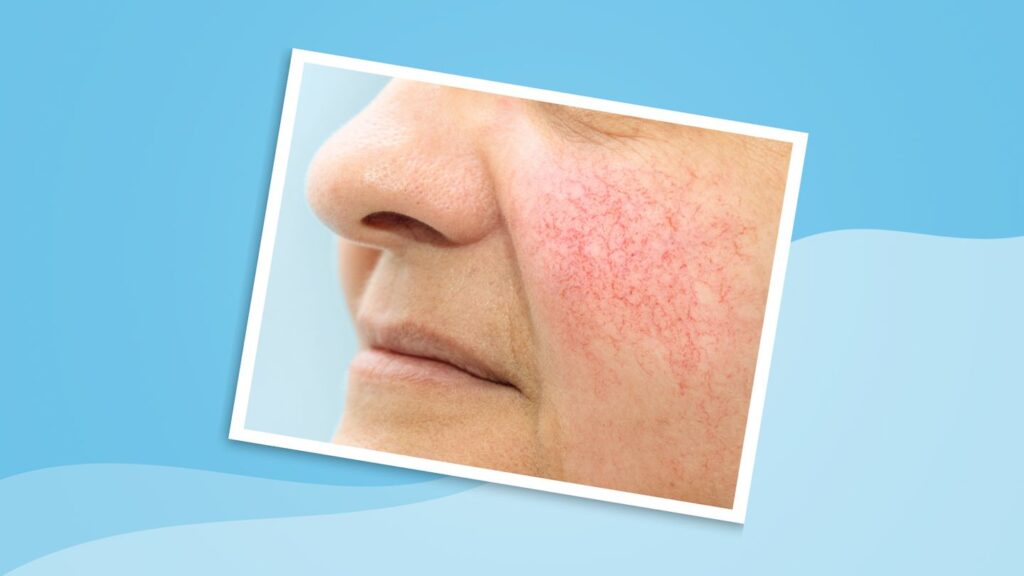 How Menopause Affects Rosacea