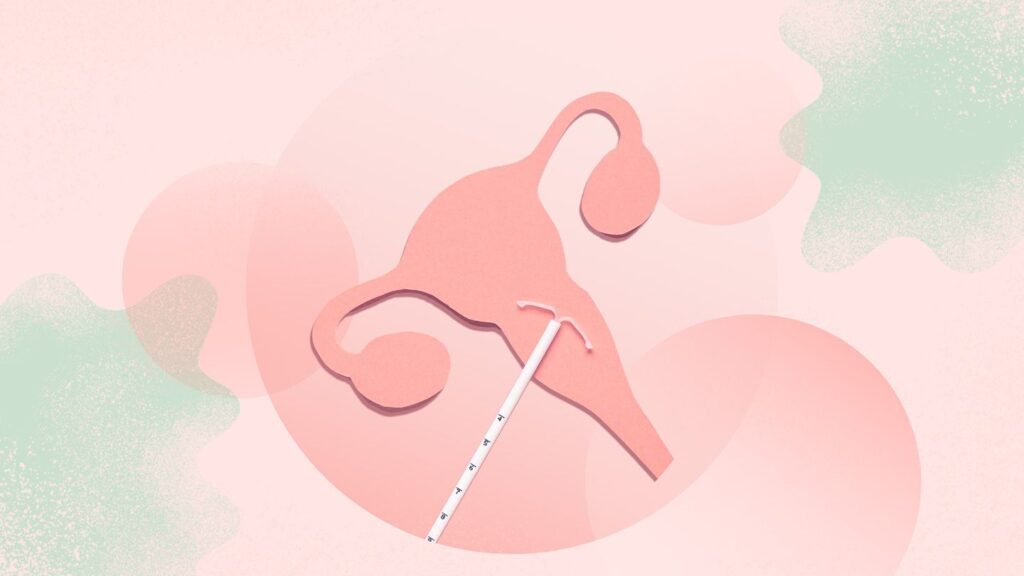 Local Anesthesia Can Relieve IUD Insertion Pain