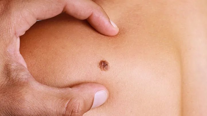 Metastatic Melanoma: Symptoms, Stages, Treatment Metastatic Melanoma: Symptoms, Stages, Treatment