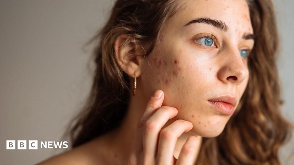 The simple skincare routine for teens that actually works – and five expert tips A young woman with acne touches her face. She has blue eyes and brown wavy hair