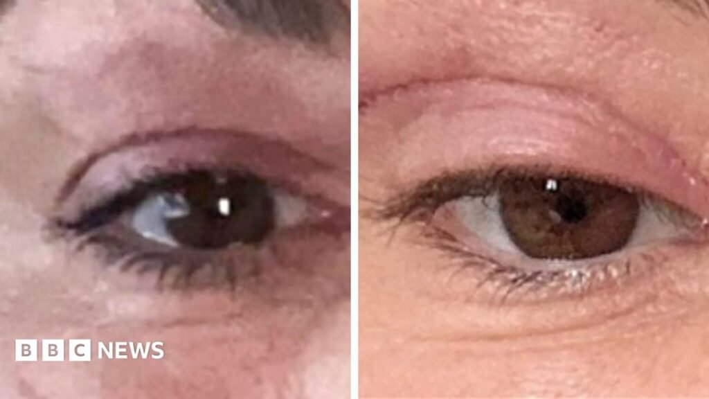 Watch: ‘My eyelids became infected – I was scared to sleep’ Side by side images of scars on eyes