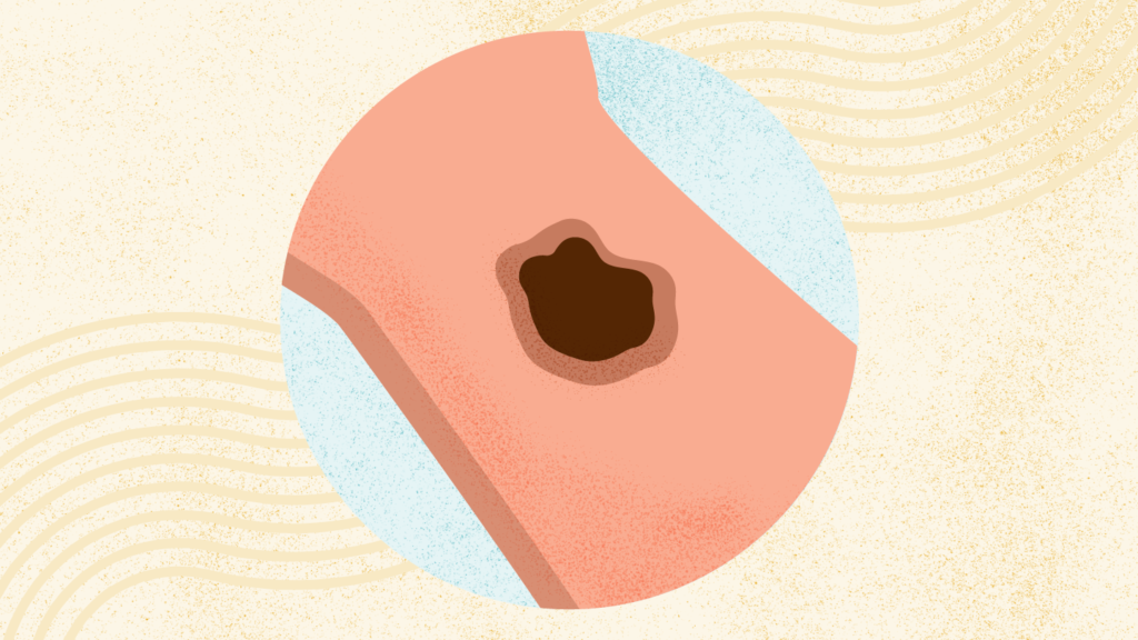 What Is Melanoma?